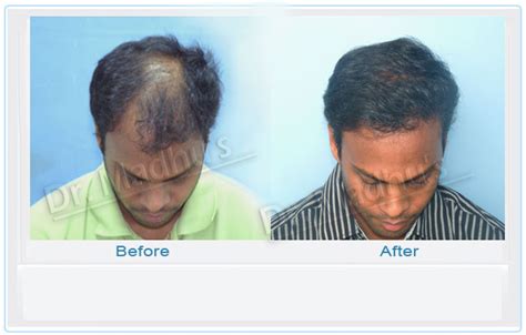 dr madhu hair transplant